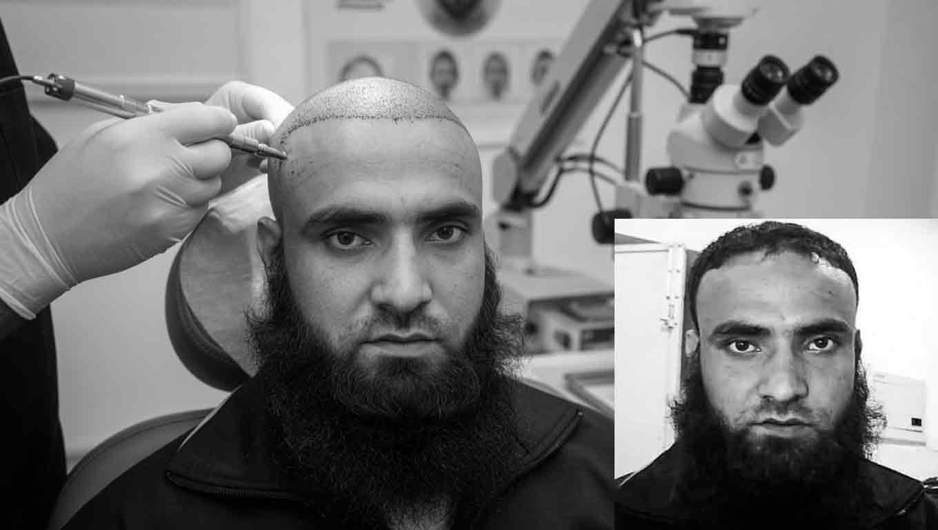 Mission Missed by a Hairline: Pakistani LeT Terrorist Infiltrated Kashmir to Set Up Sleeper Cells, Got a Hair Transplant Instead